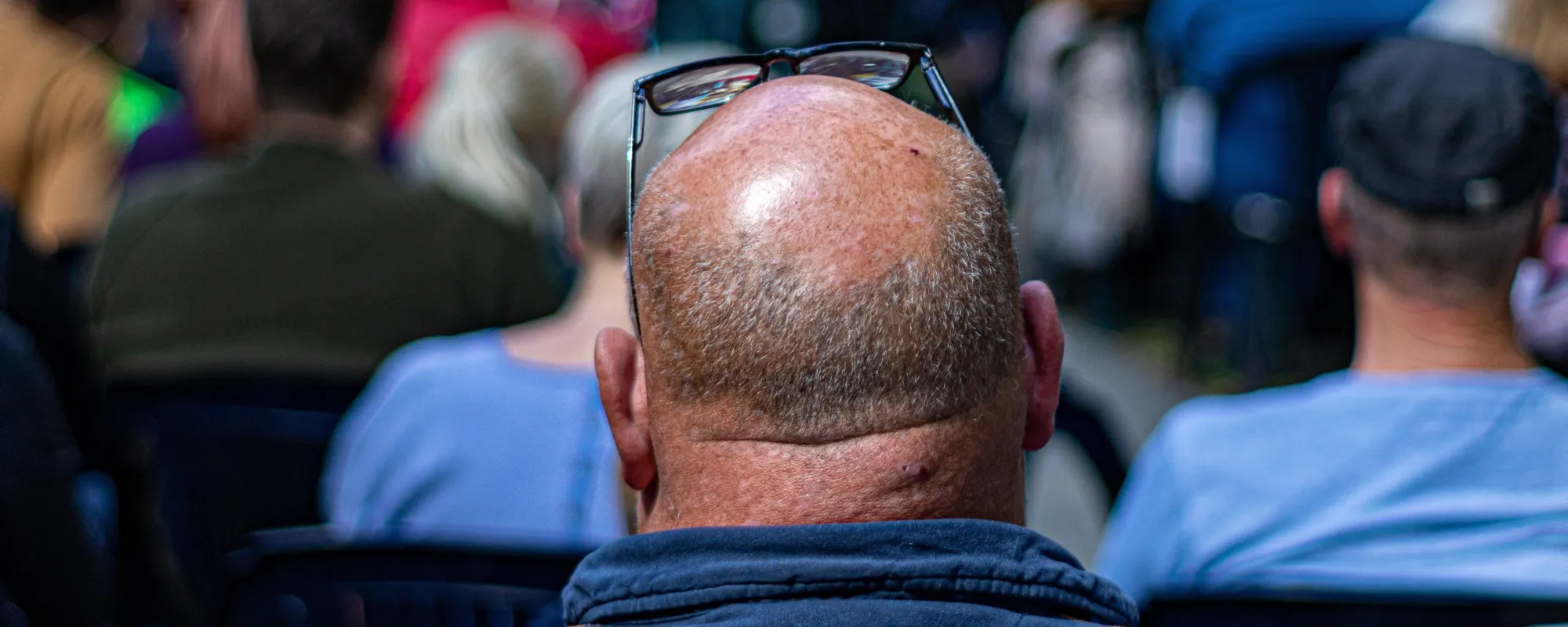 Calvizie, ecco i tre cibi da evitare a tavola per salvare i capelli