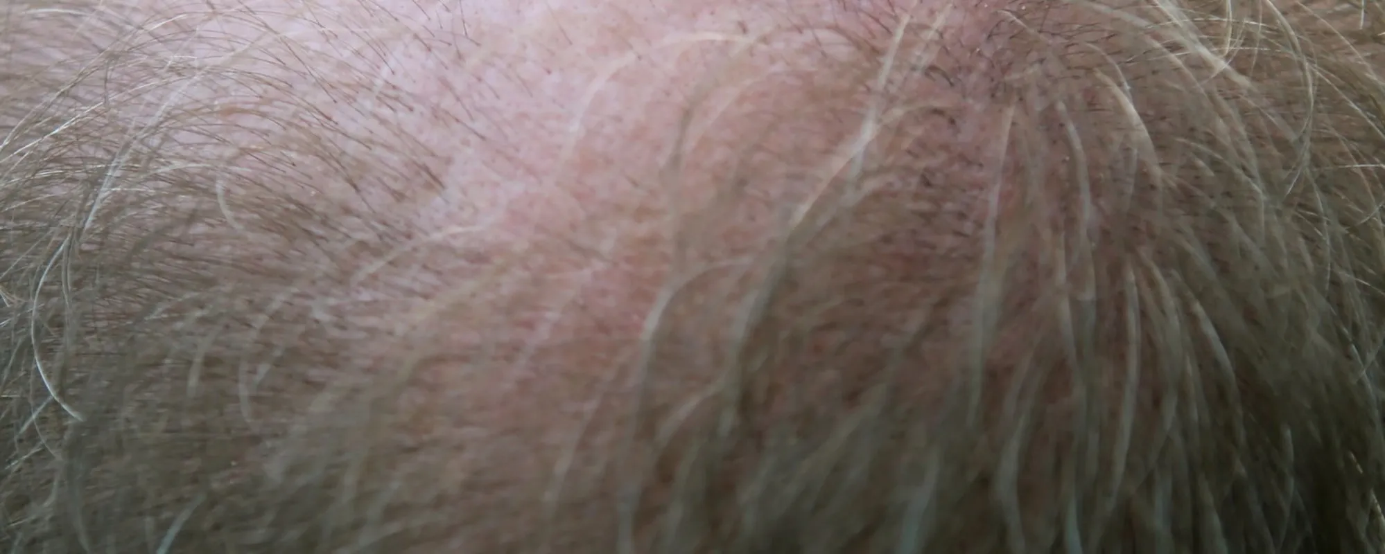 Perché cadono i capelli? La scoperta che ribalta tutto