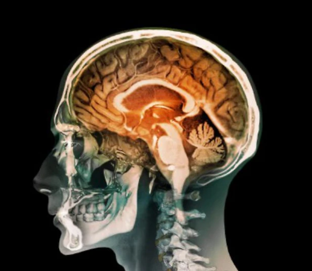 Tumore al cervello, scoperto come "far morire di fame" le cellule cancerose e fermare la diffusione