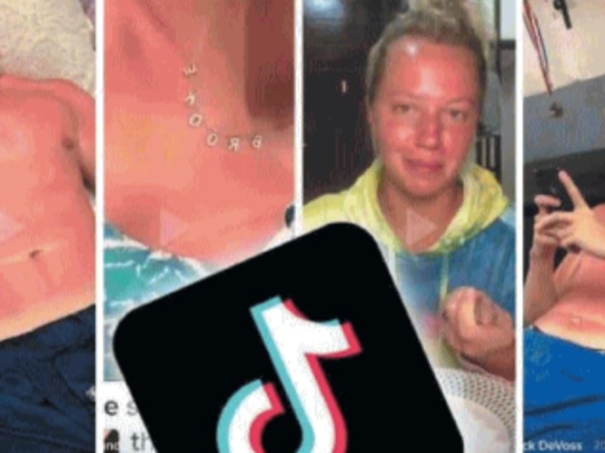 L’ultima idiozia social: fare a gara a chi si scotta di più al sole