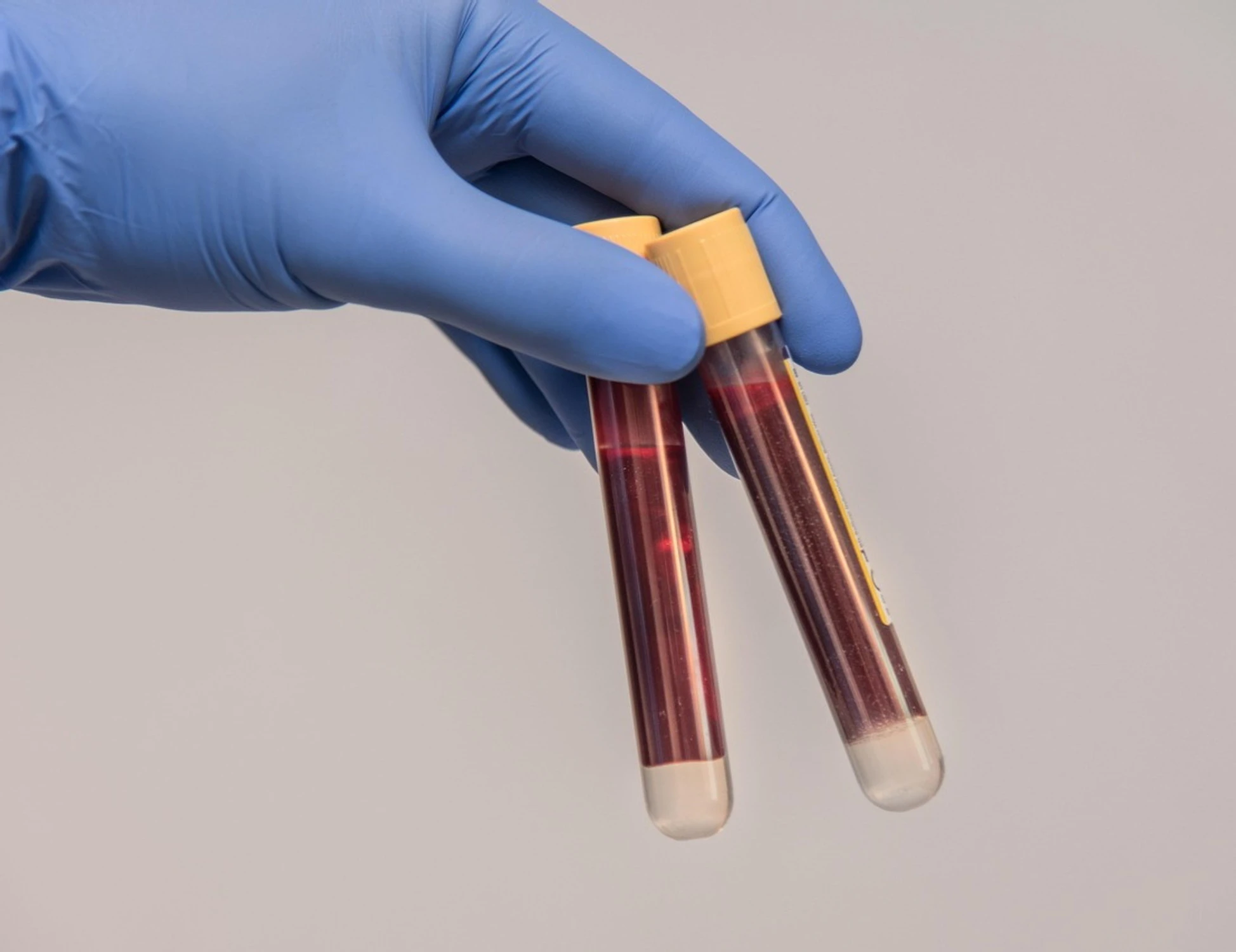 La bimba ha l'Hiv? La scelta choc dei genitori: scoppia il caso