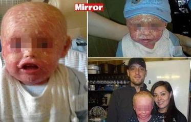 Jayden, il bambino inglese con la pelle da pesce