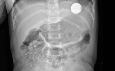 Pile al litio ingerite, 12 casi in 18 mesi: perché è un'emergenza medica