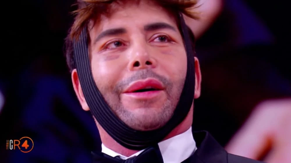 CR4, Giacomo Urtis sconvolge in diretta: faccia sfregiata, si presenta così. E Alfonso Signorini lo deride