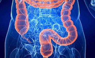 Tumore al colon-retto, cosa devi mangiare sempre per ridurre la minaccia