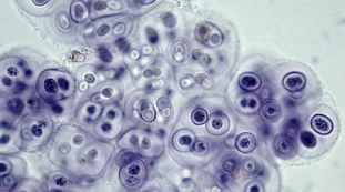 Virus CCHF, nuovo caso in Europa: si rischiano occhi sanguinanti, febbre ed emorragia