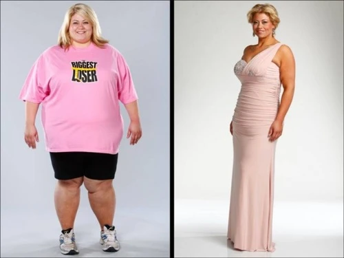 Obesità, aumentano gli interventi di chirurgia estetica dopo il dimagrimento