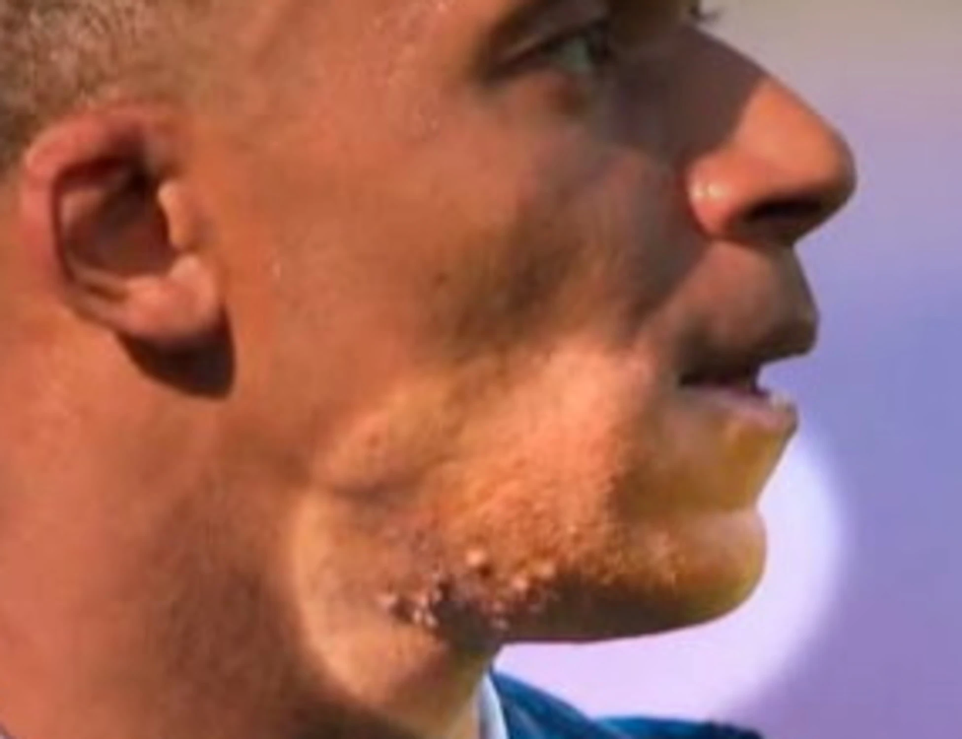 Kylian Mbappè, il pesante sospetto su quelle bolle in faccia