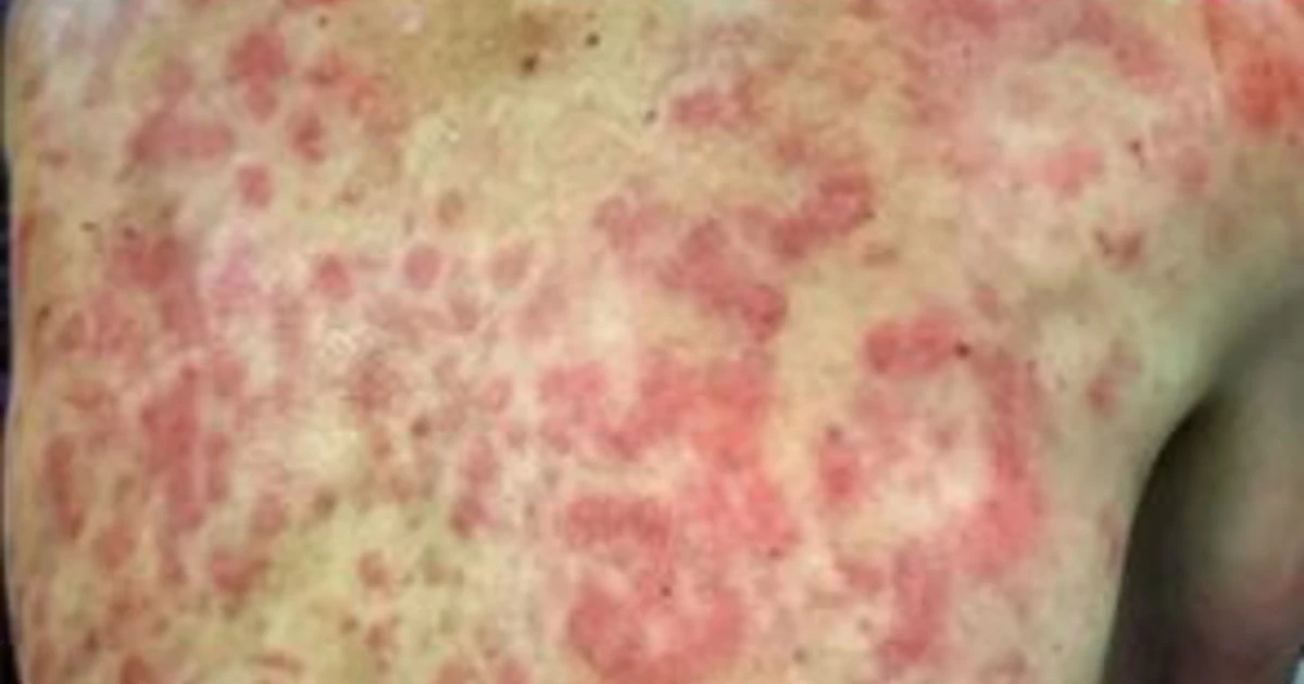 Ciclismo, choc al Giro del Delfinato: grandinata killer, il ghiaccio devasta le schiene di Declerq e Chevalier