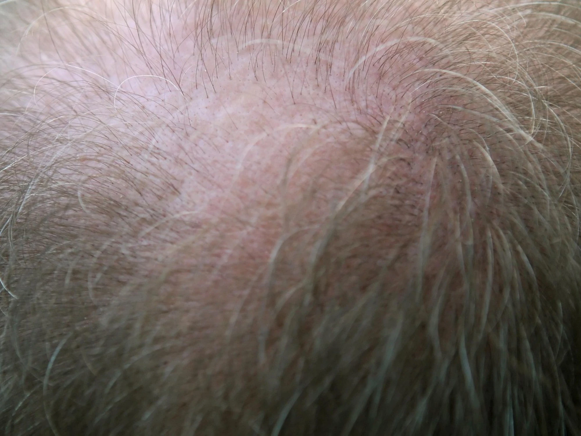 Arezzo, clinica abusiva per trapianti di capelli: paziente finisce in coma, due indagati