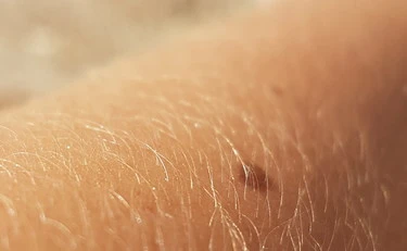 Cancro alla pelle, la nuova scoperta per ridurre del 42% il rischio recidiva 