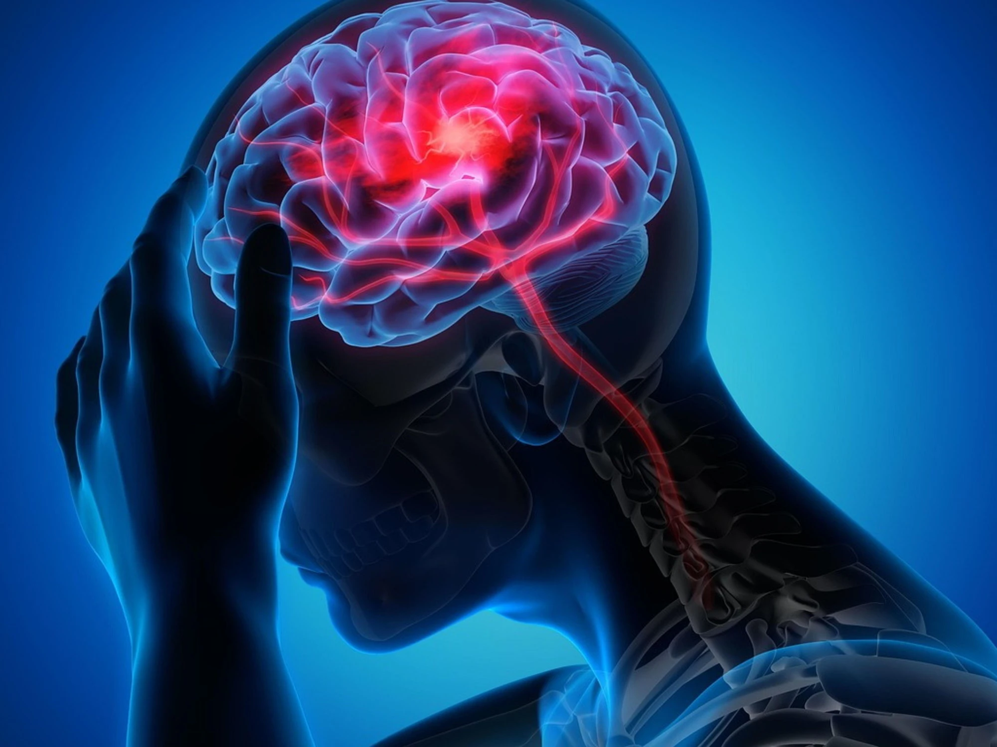 Emicrania aurea, ecco cosa scatena il mal di testa