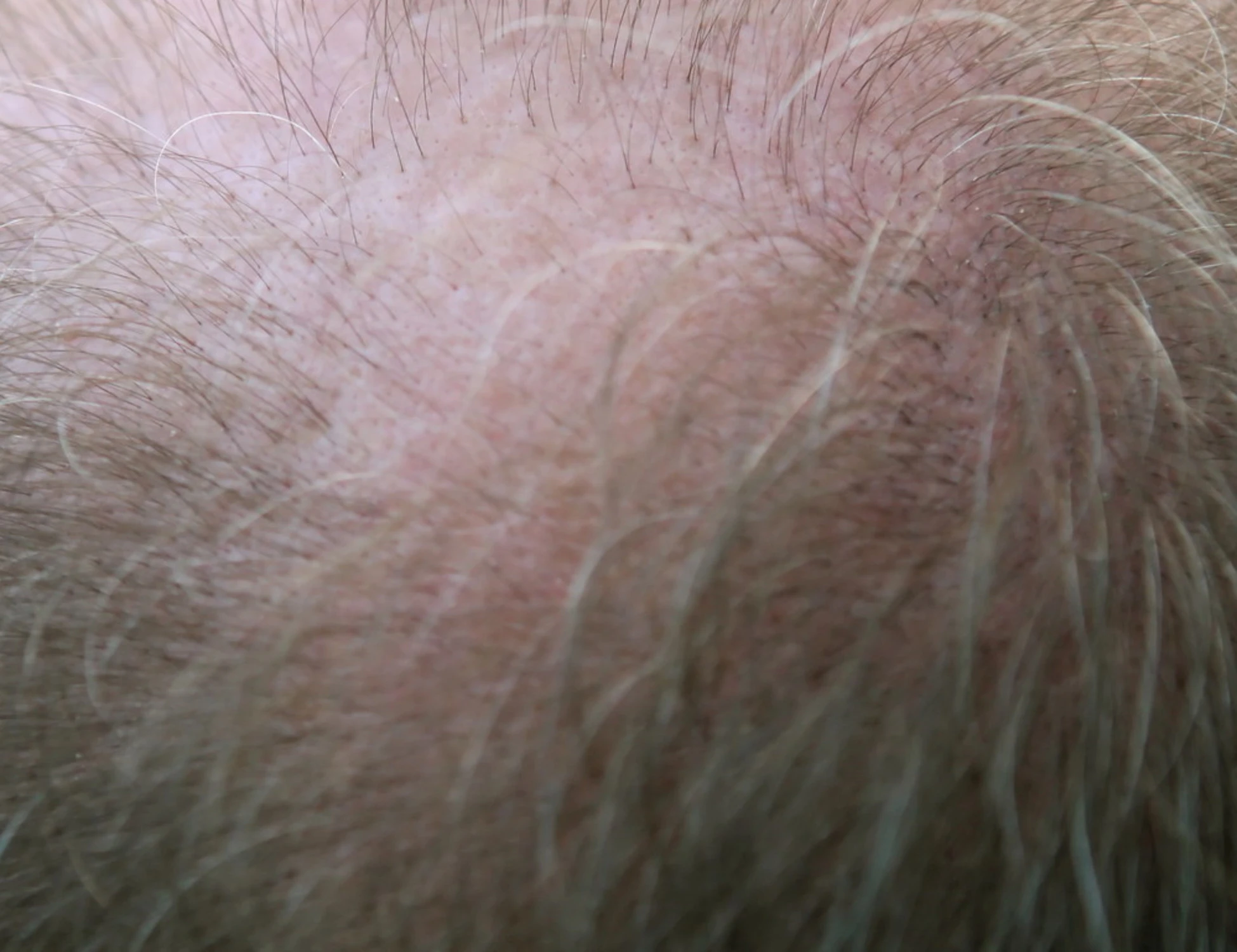 Perché cadono i capelli? La scoperta che svela il "doppio colpo " che scatena attacco autoimmune  