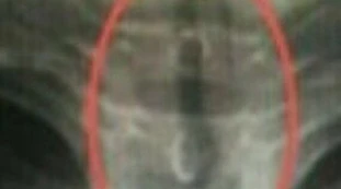 Kenya, beve l'acqua e si ritrova questo nella gola: orrore senza precedenti, cosa state vedendo
