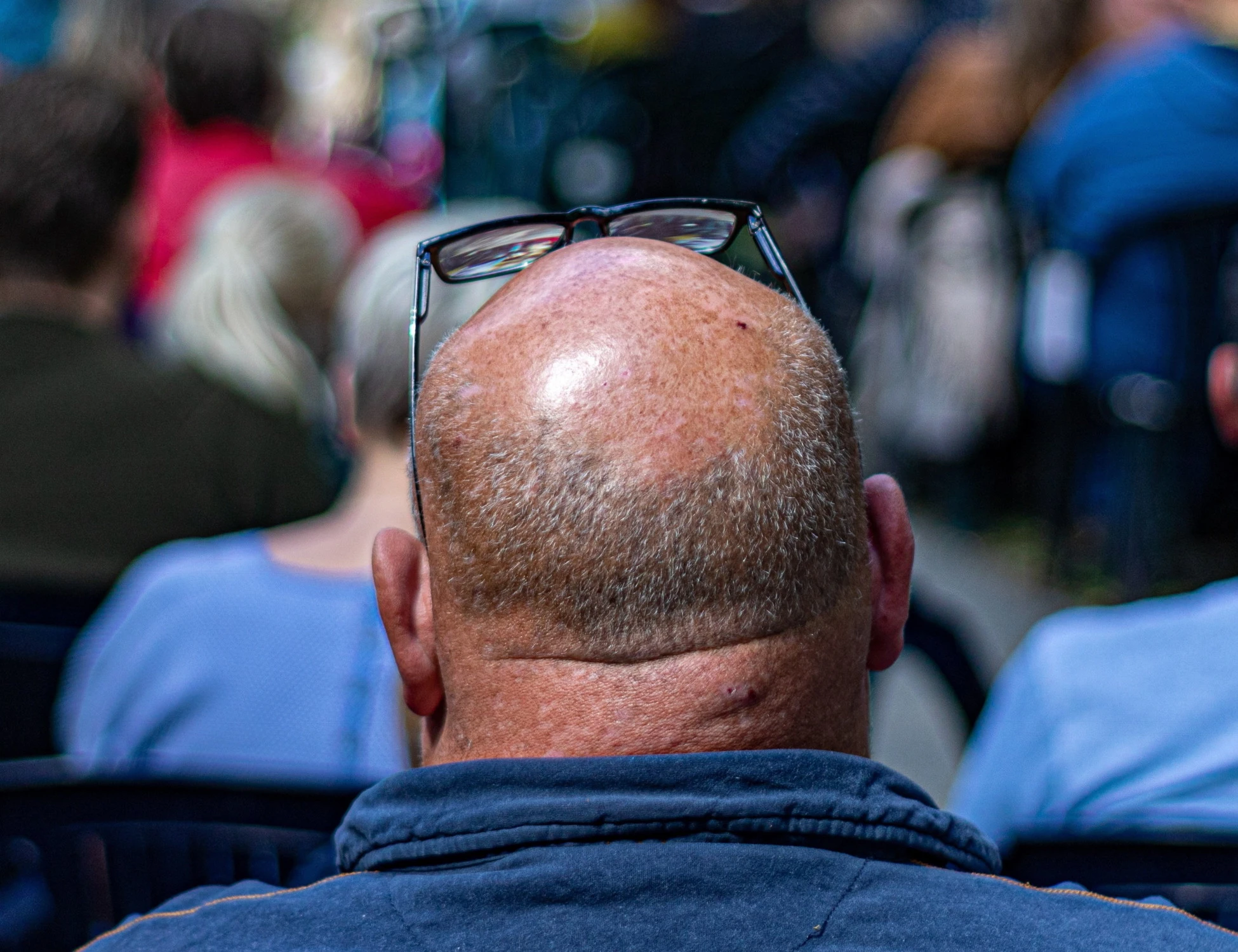 Calvizie, ecco i tre cibi da evitare per salvare i capelli