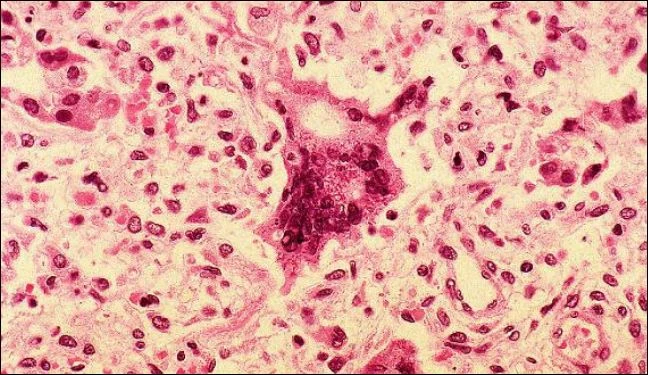 Batterio New Delhi, paura in Toscana: 64 casi e 17 morti sospette