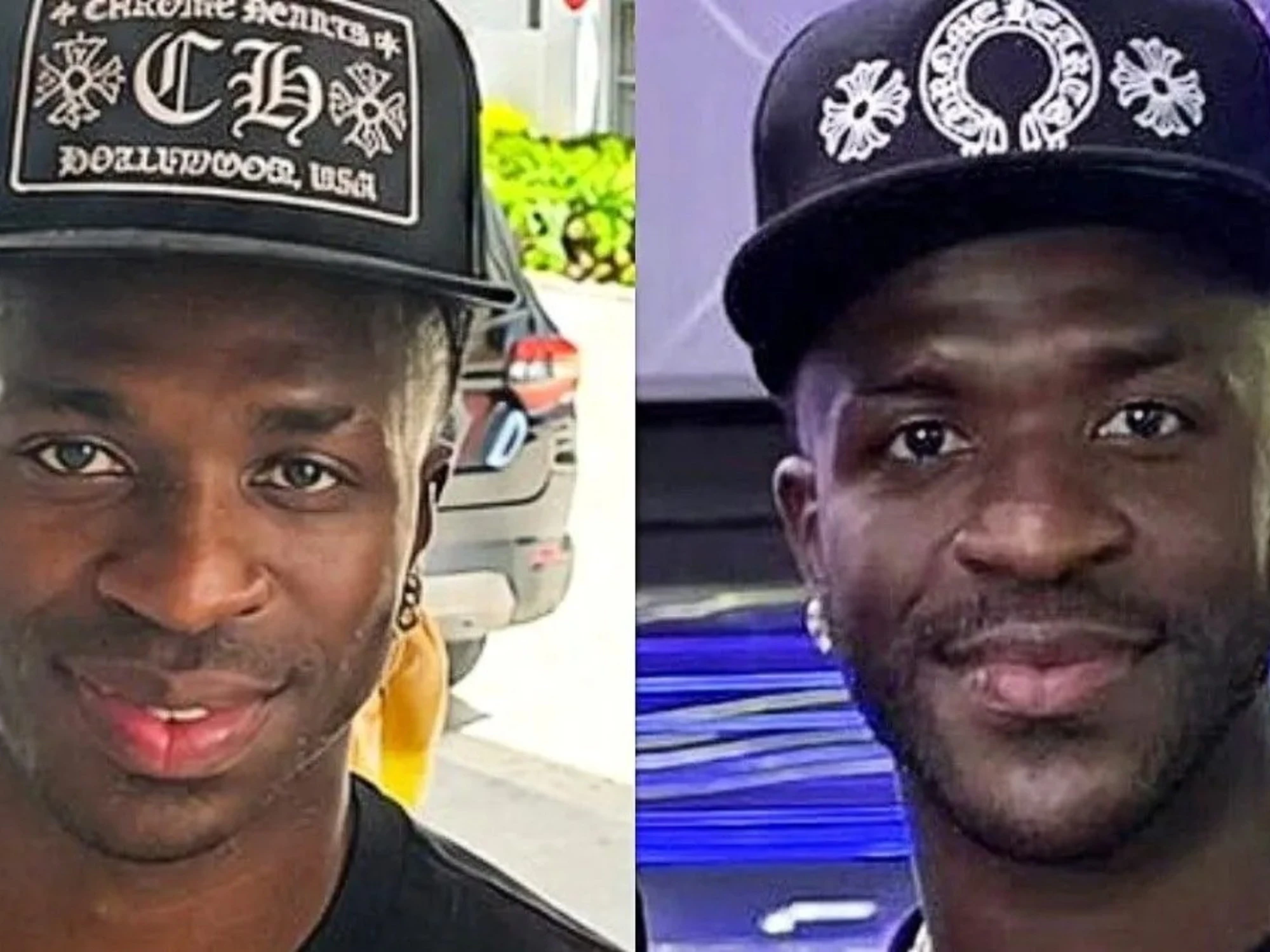 Vinicius, il volto stravolto dall'intervento: eccolo prima e dopo