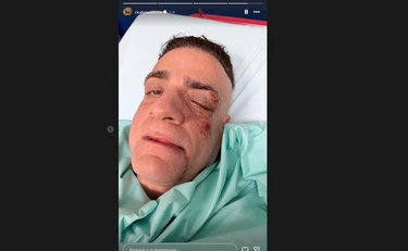 Cicalone choc, "infami veri": picchiato dai borseggiatori, com'è ridotto