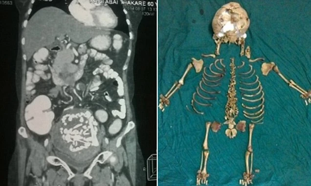 India, incinta nel 1978, vive con lo scheletro del figlio nella pancia per 36 anni