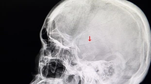 Napoli, "cranio trapassato": 12enne in ospedale con una chiave conficcata in testa, aggredito da un coetaneo