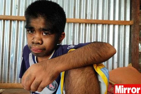 Ha 13 anni, sta diventando un lupo. Questa malattia lo devasta: com'è