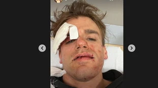 Jacopo de iPantellas massacrato: "Volevano uccidermi". Foto-choc, com'è ridotto