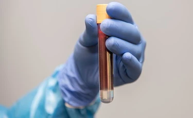 Tumore al pancreas, diagnosi precoce: il segreto è nel sangue