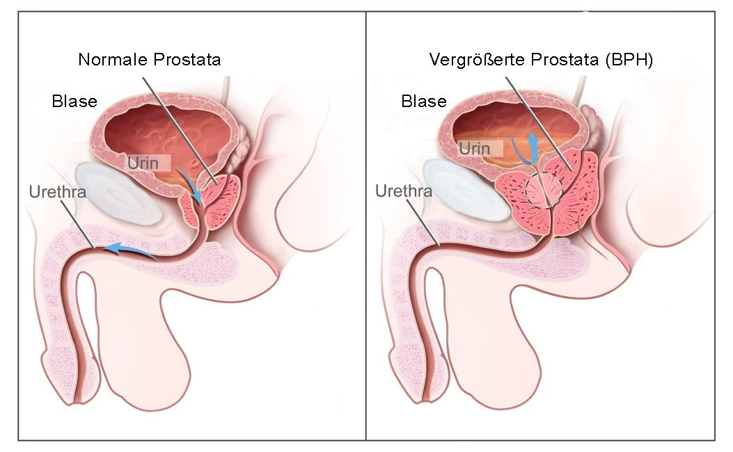Tumore alla prostata, la prevenzione passa anche per il vino e il sesso