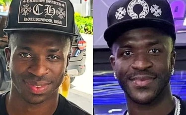 Vinicius, il volto stravolto dall'intervento: eccolo prima e dopo
