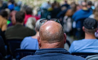 Calvizie, ecco i tre cibi da evitare per salvare i capelli