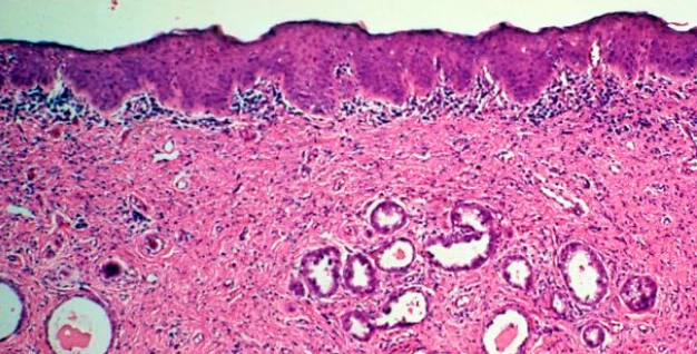 Tumore, la ricerca che può cambiare tutto: le cellule cancerose esposte all'assenza di gravità muoiono