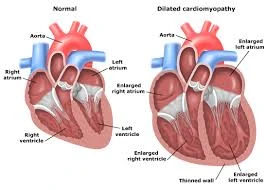 Cardiomiociti dalla riprogrammazione di cellule staminali di pazienti con Dcm
