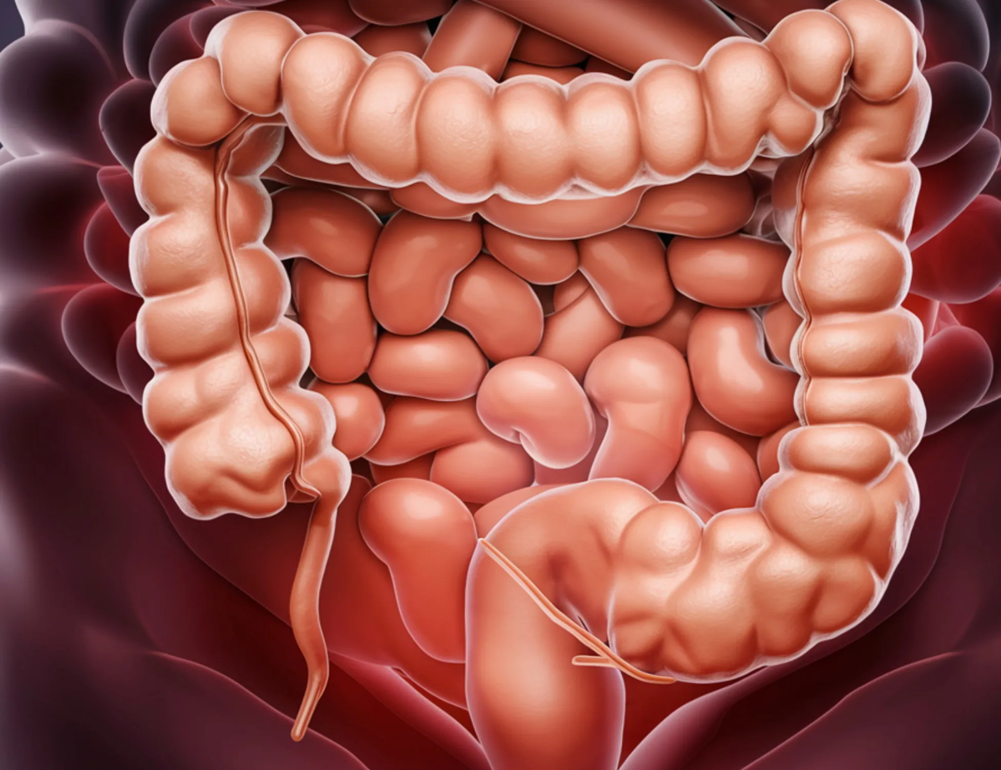 Colon irritabile, allarme rosso per il cambio di stagione: cosa può accadere