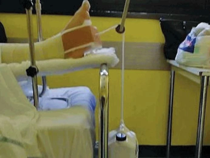 Napoli, vergogna nell'ospedale: la gamba del paziente appesa a una tanica