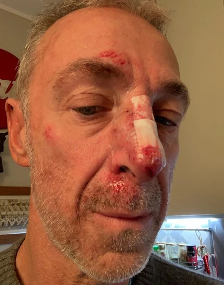 Linus, paura per il mito di Radio Deejay: "Naso rotto e tre punti per una caduta a piedi"