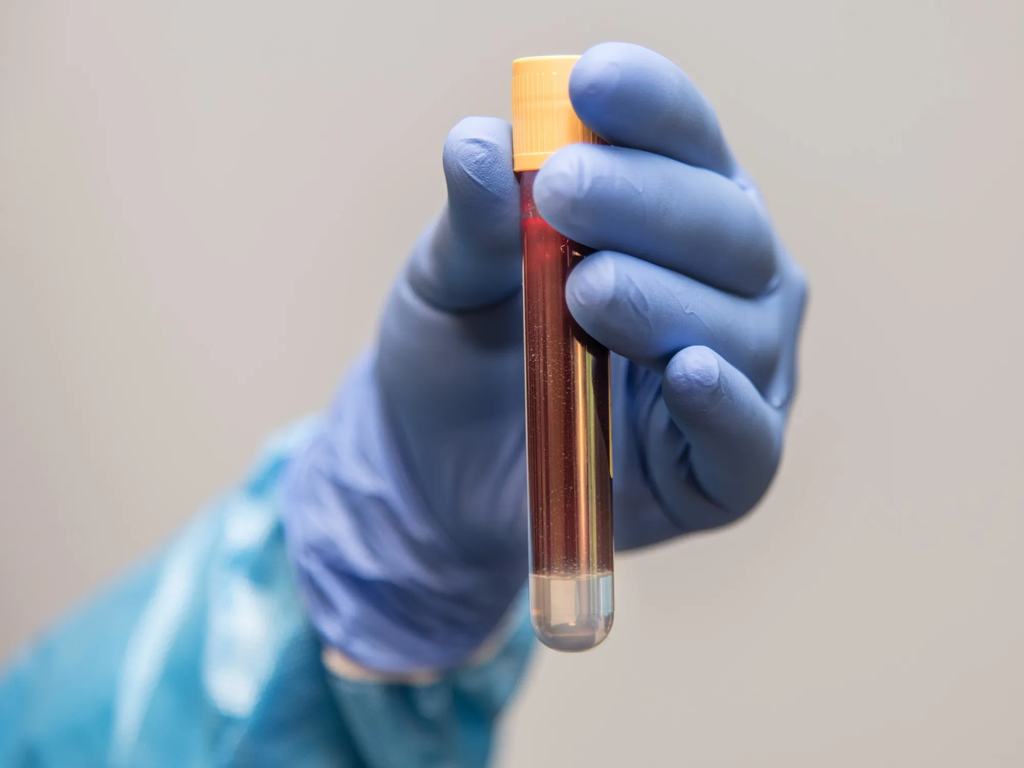 Tumore al pancreas, diagnosi precoce: il segreto è nel sangue