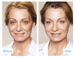 Gli skinbooster promossicome 'terapia per la pelle'