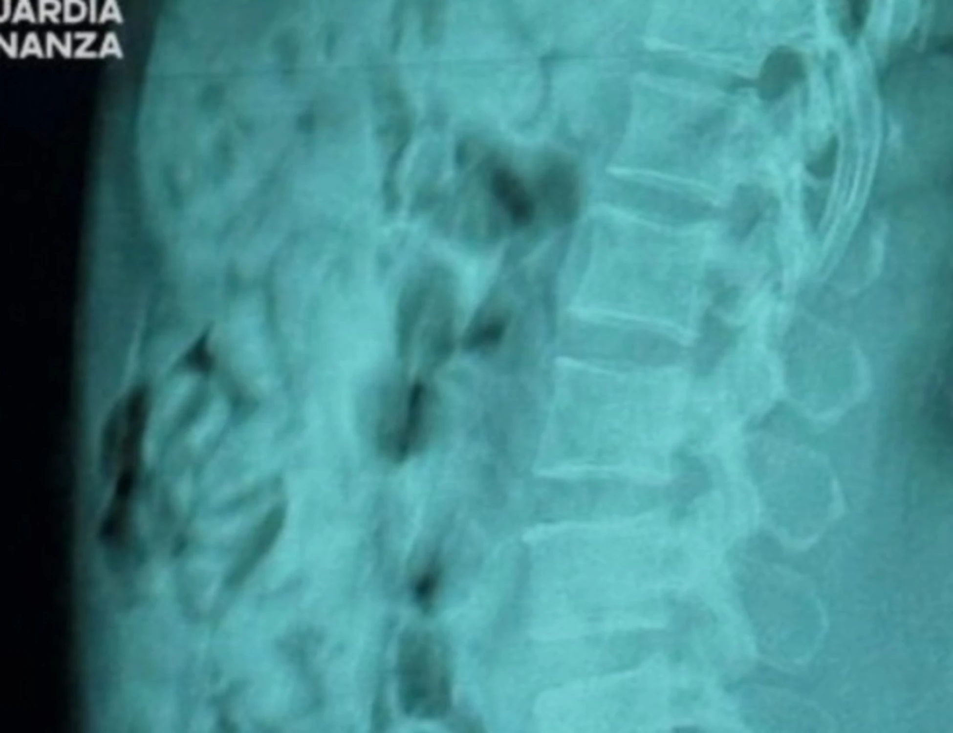 Bergamo, 120 ovuli di eroina nello stomaco: nigeriana arrestata