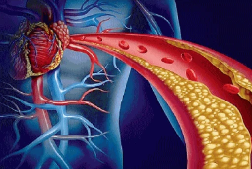 Colesterolo buono? Lo studio che smonta il falso mito: come puoi morire d'infarto