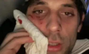 Bresh ridotto così, lividi e sangue: cosa è successo?