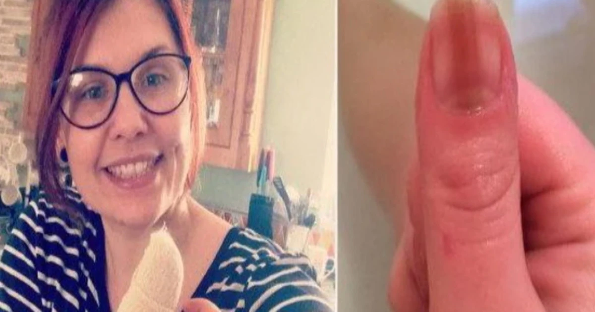 Regno Unito, "solo un'imperfezione dell'unghia? No, ecco di cosa si tratta": perché una donna ha rischiato di morire