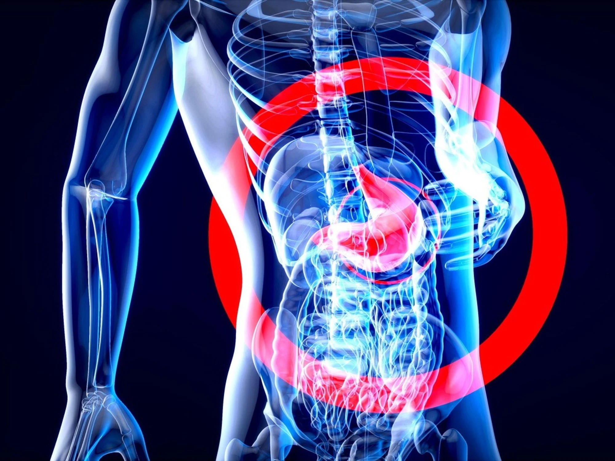 Helicobacter pylori, l'ospite silenzioso che può portare a lesioni cancerose