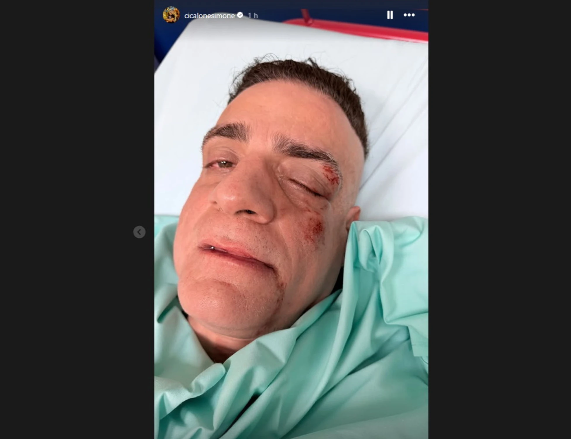 Cicalone choc, "infami veri": picchiato dai borseggiatori, com'è ridotto