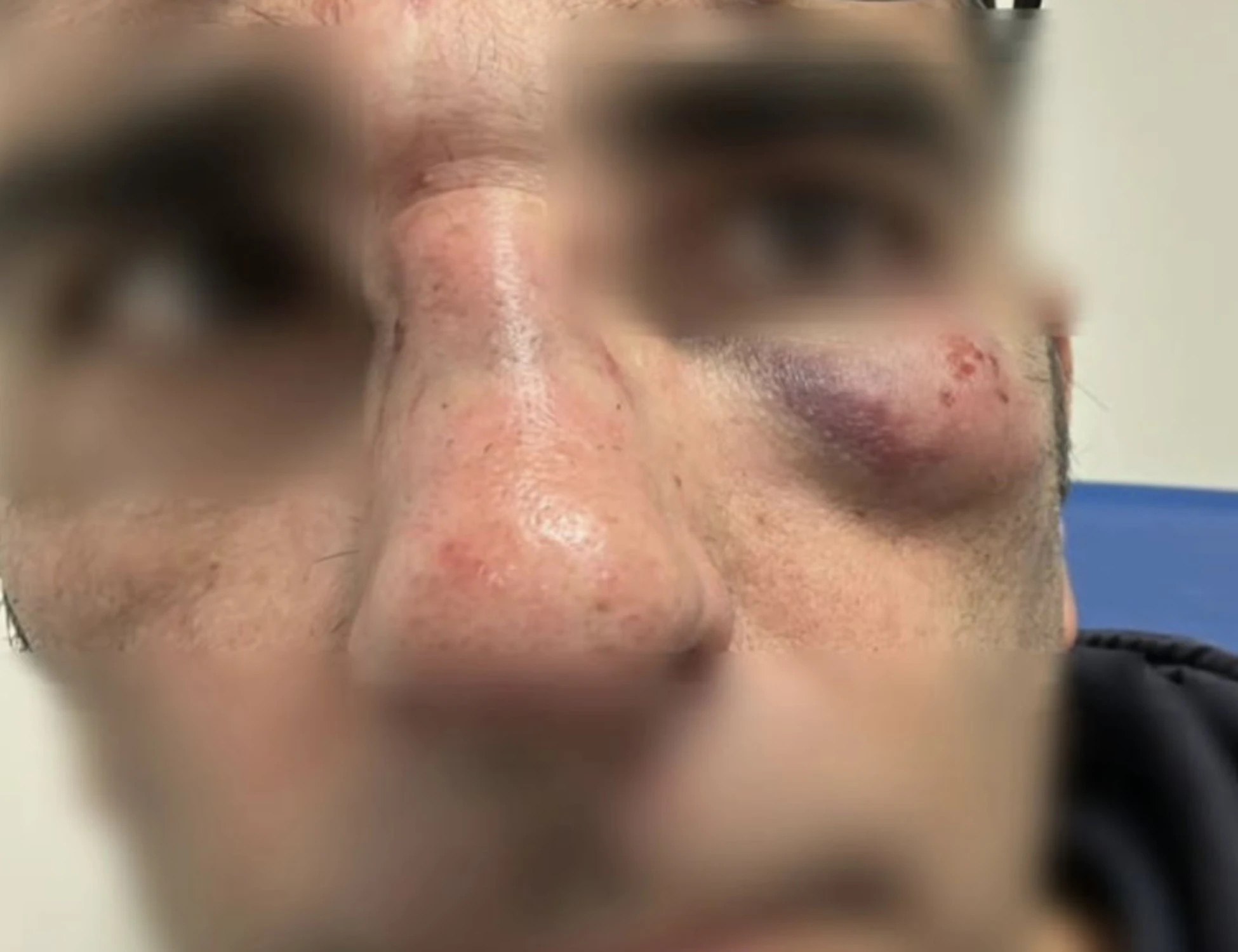 Anagni, "biglietto prego". E l'immigrato lo massacra: come ha ridotto Daniele Stefanucci