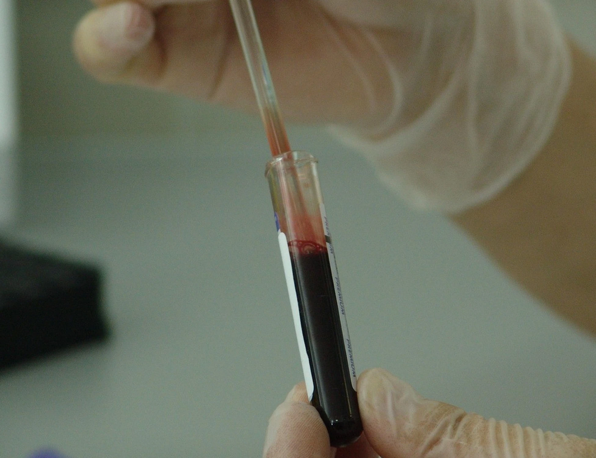Hiv, il ritorno in Italia: +24% in un anno, la regione più colpita