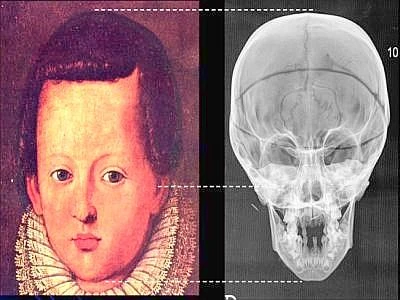 Bambini dei Medici rachitici per poca luce e troppo latte materno