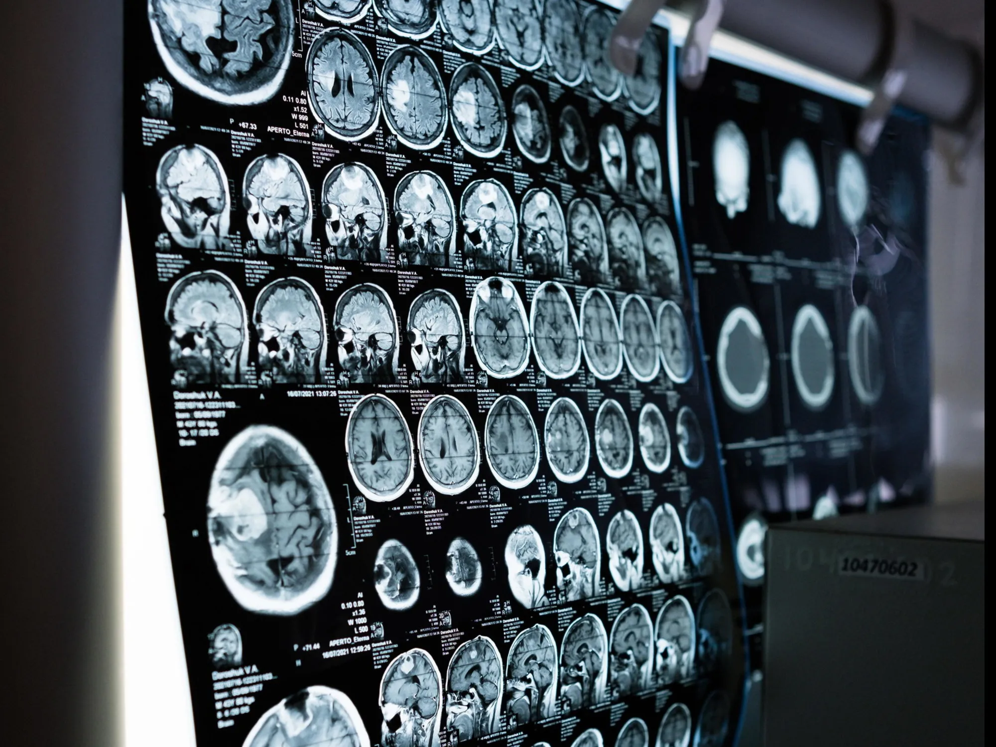 Tumore al cervello e testosterone, il legame: allarme per gli uomini