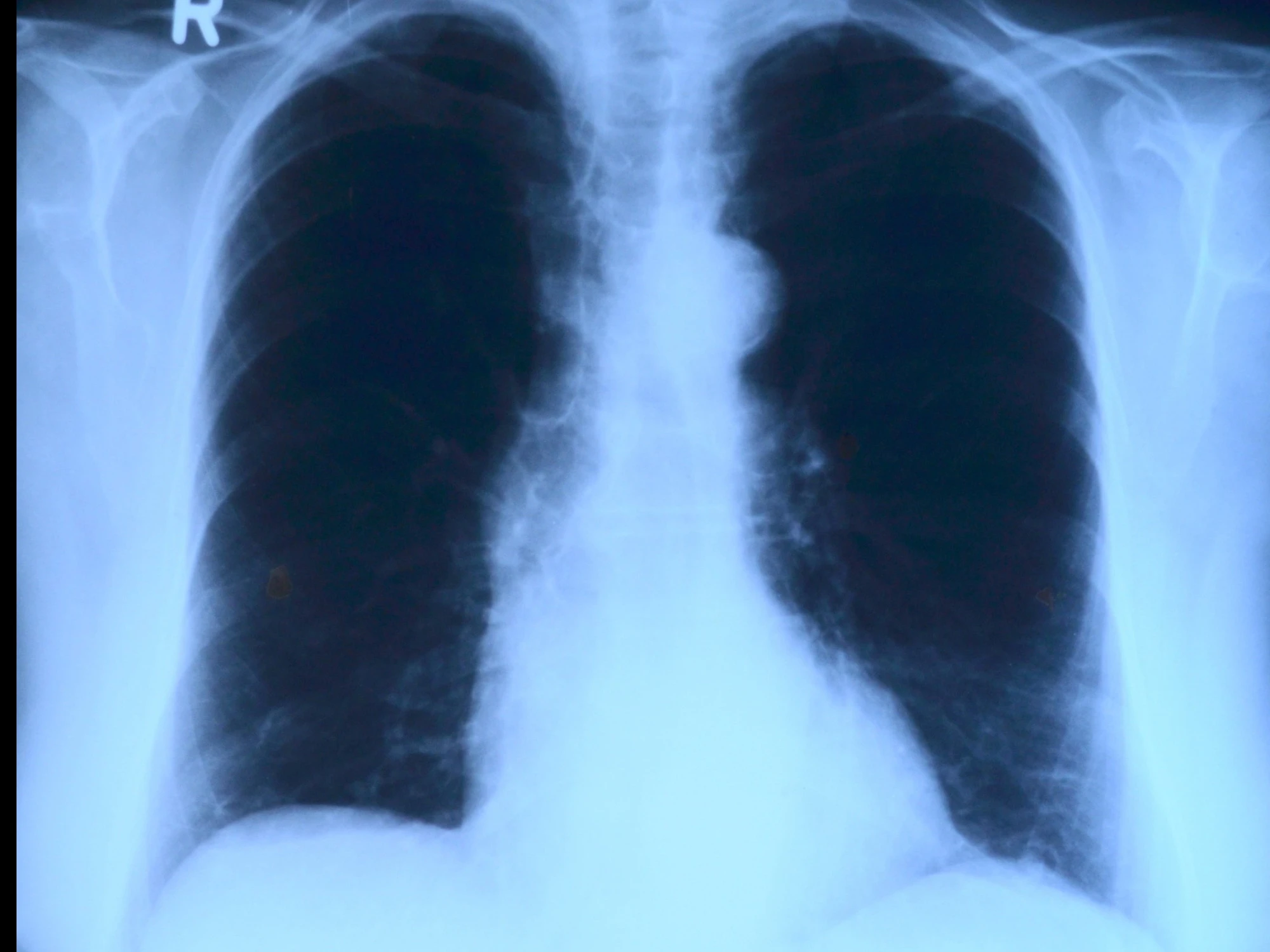 Cancro ai polmoni, l'infiammazione che anticipa la malattia
