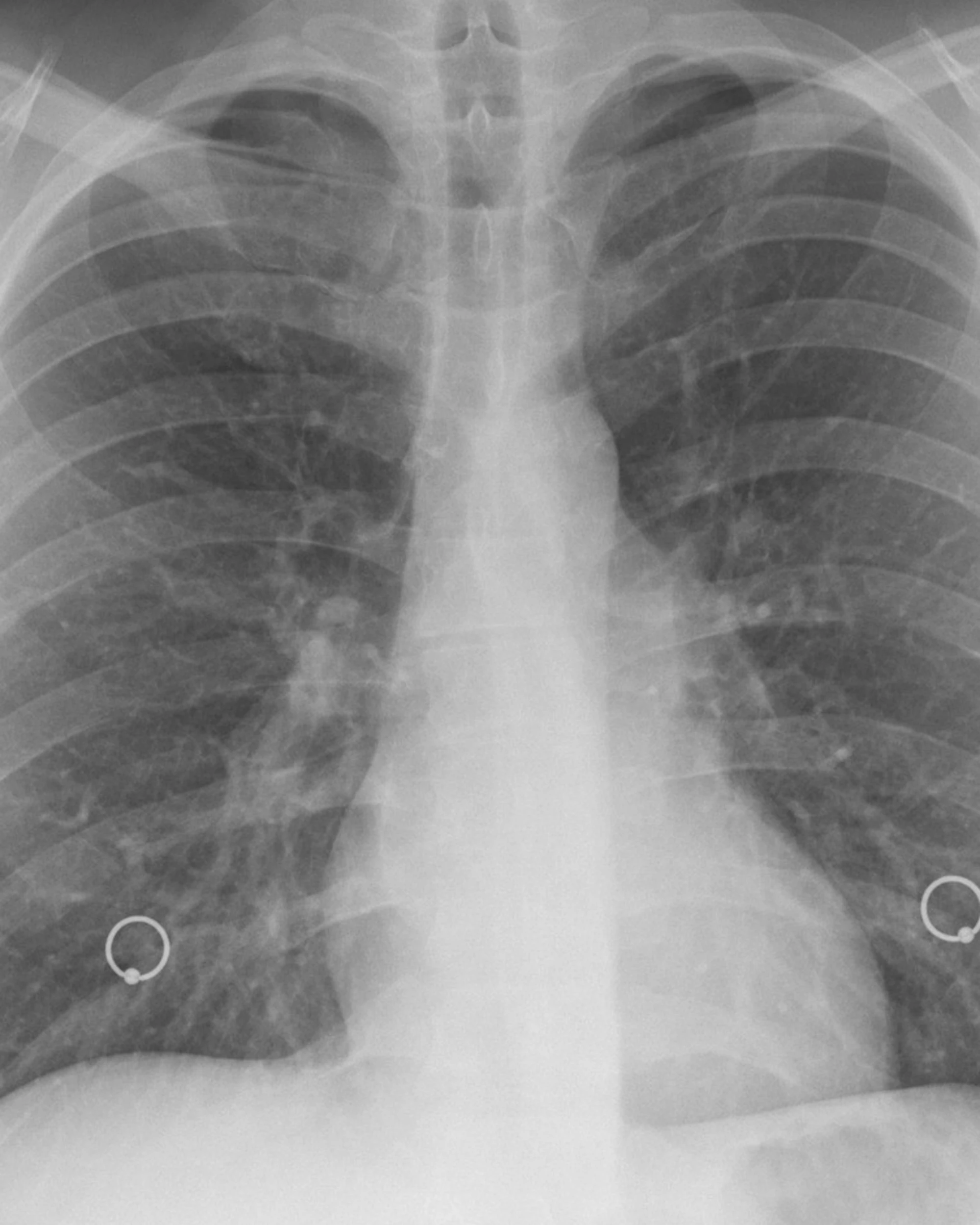 Tumore al polmone "non operabile"? La nuova tecnica cambia tutto