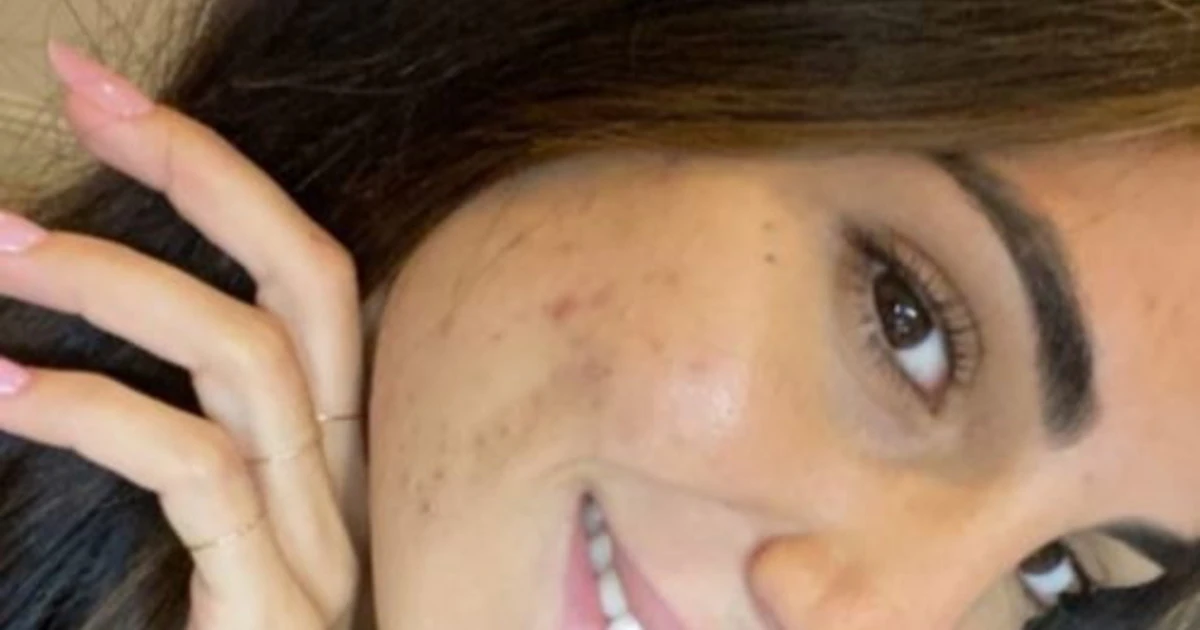 Giulia De Lellis, i suoi brufoli al centro della scena. Piovono critiche nei suoi confronti